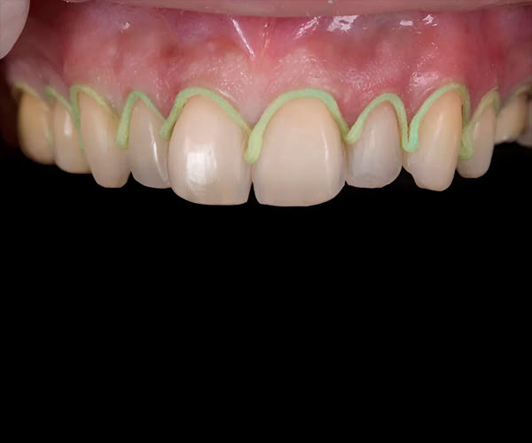 Step in restorative dentistry with RETRAX® Cord ensuring accurate and high-quality impressions