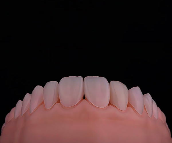 Using RETRAX® Retraction Cord in preparation for digital or conventional dental impressions