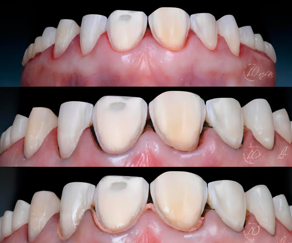 Dental procedure showing RETRAX® Cord creating clear margin exposure for an impression