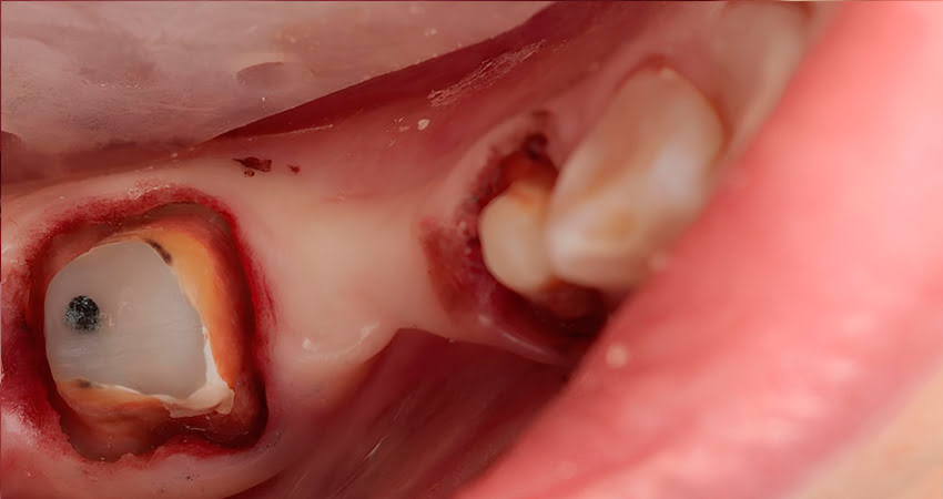 After – dry field achieved within minutes using Retrax® Pellets during bridge removal