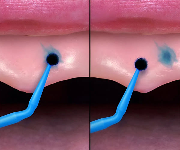 Clinician applying Hydent® Stick to denture for accurate tissue marking and high-spot detection, patient-friendly and mess-free