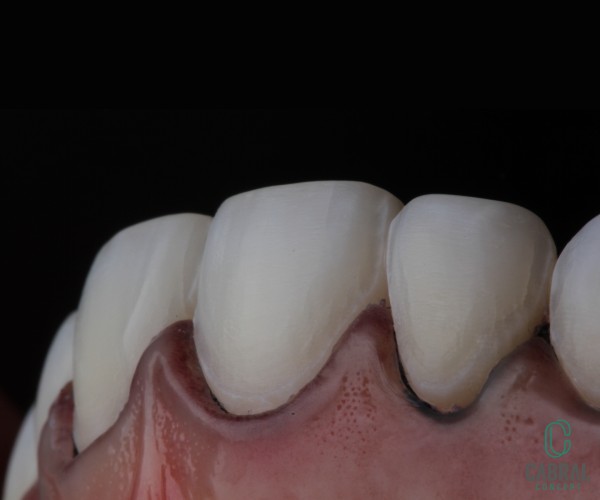 retraction-cords-tooth-10