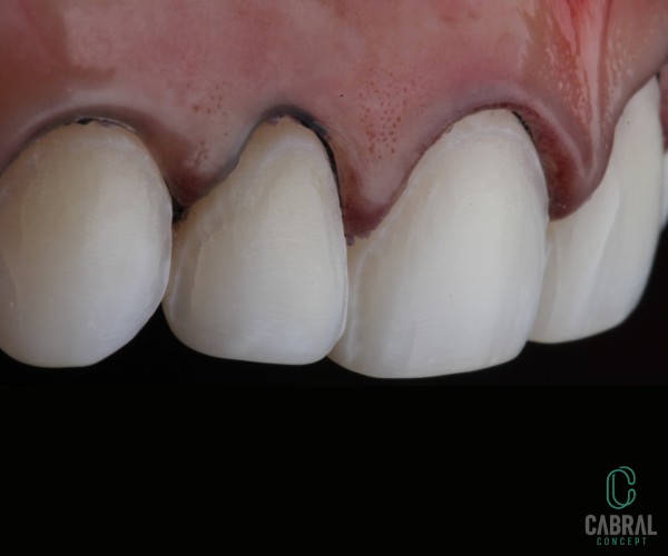 retraction-cords-tooth-11