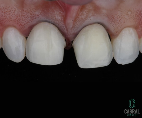 retraction-cords-tooth-12