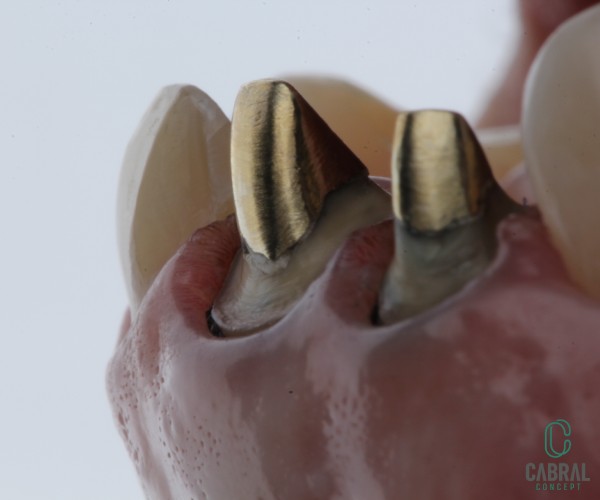 retraction-cords-tooth-13