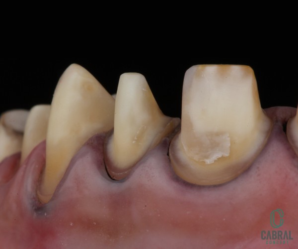 retraction-cords-tooth-14