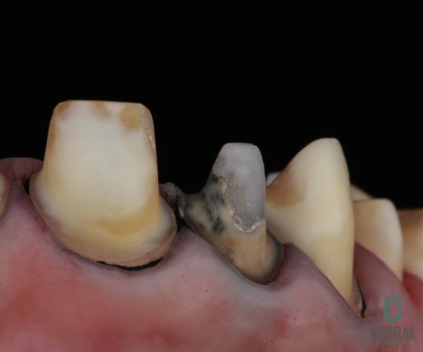 retraction-cords-tooth-15