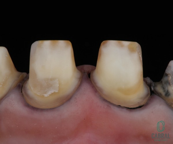 retraction-cords-tooth-16