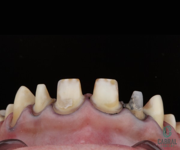 retraction-cords-tooth-17