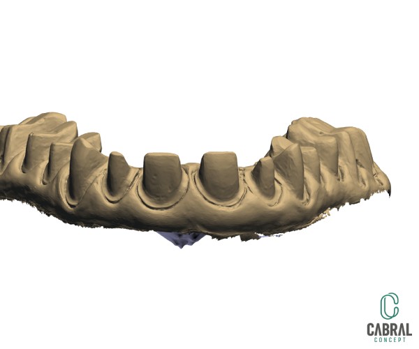 retraction-cords-tooth-18
