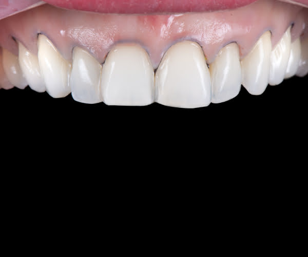 retraction-cords-tooth-6