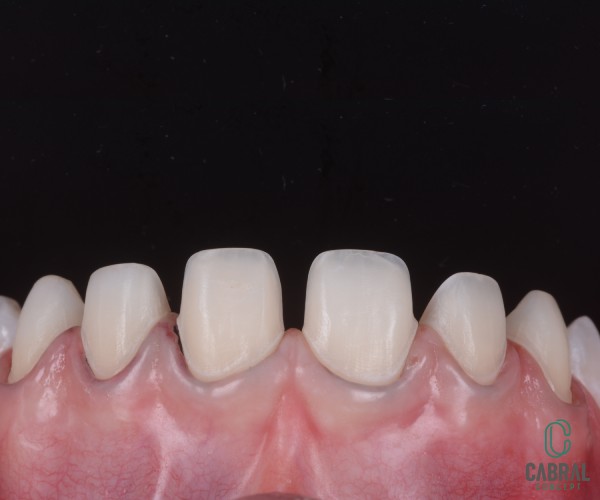 retraction-cords-tooth-7