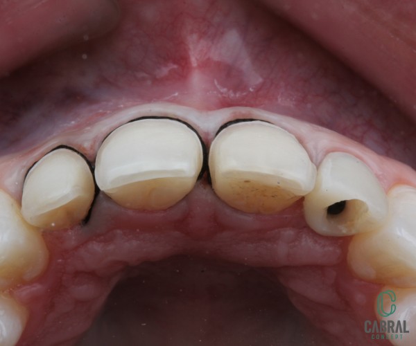 retraction-cords-tooth-8