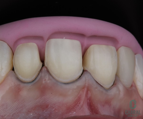retraction-cords-tooth-9