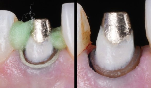 hemostasis-pellets-slide-2