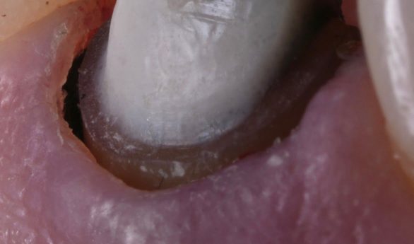 hemostasis-pellets-slide-3