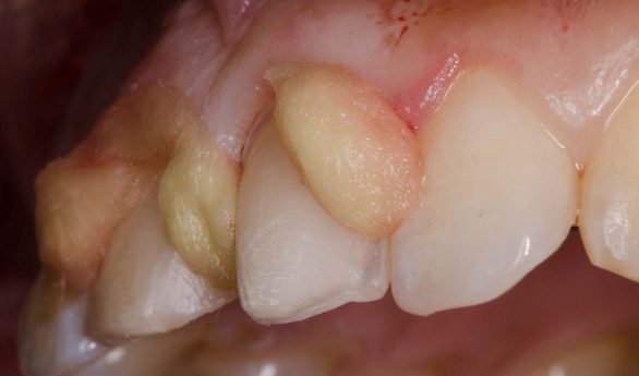 hemostasis-pellets-slide-4