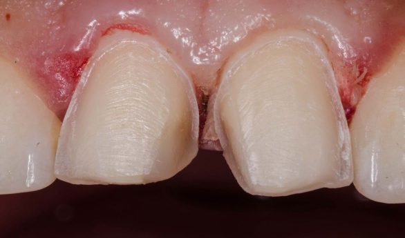 hemostasis-pellets-slide-5