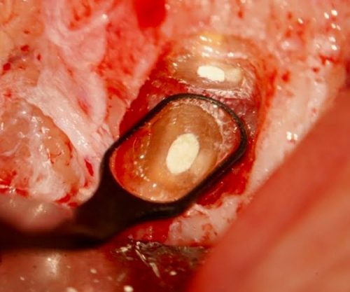 Dental professional managing fluids and tissue retraction with Retrax® products for successful endodontic outcome