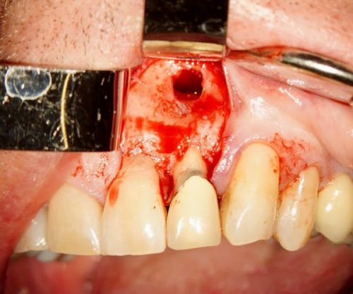 Step in endodontic therapy showing Retrax® tools aiding accurate instrumentation and isolation