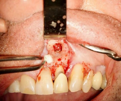 Using Retrax® Retraction Cord to achieve clear margin exposure in endodontic restoration