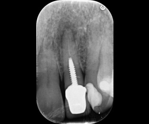 Clinician placing Retrax® Pellets during root canal treatment for a dry operative field