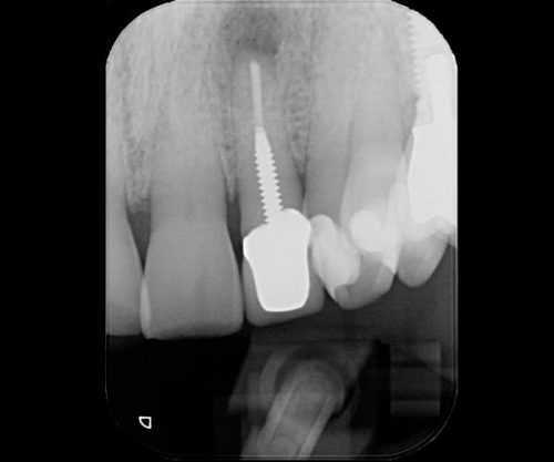 Endodontic procedure using Retrax® products for precise tissue and fluid control